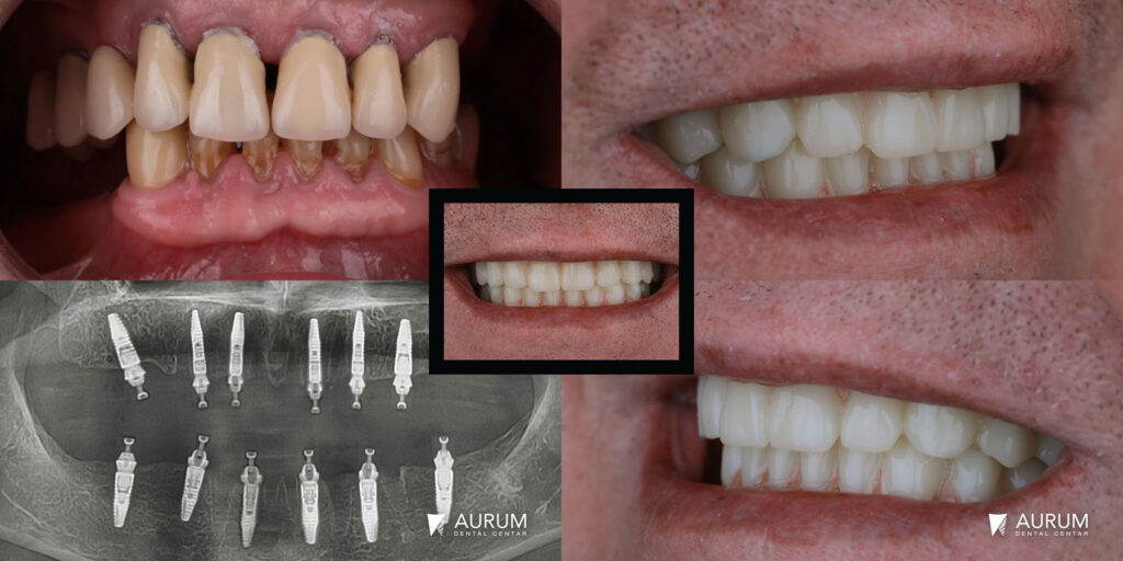 Zahnimplantate All On 6 Provisorisch Aurum Dental Centar Banja Luka